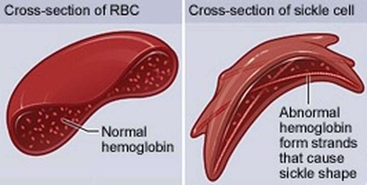 Po lewej stronie zwykła krwinka, po prawej – sierpowata; tak duże różnice morfologiczne są wynikiem nieprawidłowej budowy zaledwie jednego białka - Czy możemy zostać superbohaterami? Nauka odpowiada - dokument - 2020-11-06