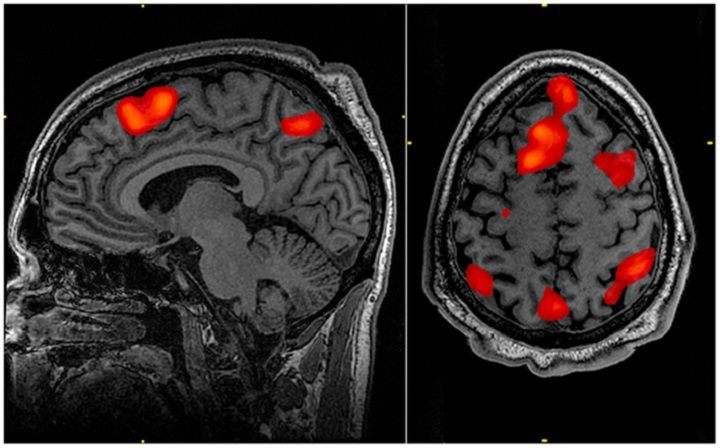 Tomografia fMRI umożliwia uzyskanie obrazu nie tylko struktury, ale i aktywności mózgu – czerwone obszary charakteryzują się wzmożonym metabolizmem. - Czy cyberpunk jest możliwy? Kopiowanie umysłu to trudna sprawa - dokument - 2021-06-21