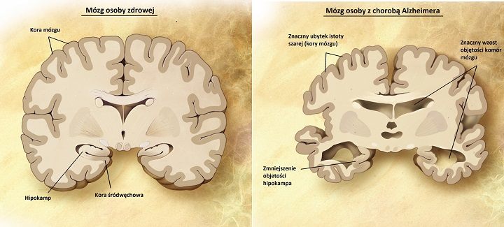 W chorobie Alzheimera, objawiającej się między innymi bardzo poważnymi zaburzeniami pamięci, stwierdza się znaczne zmniejszenie objętości kory mózgowej i hipokampu. - 2019-04-23