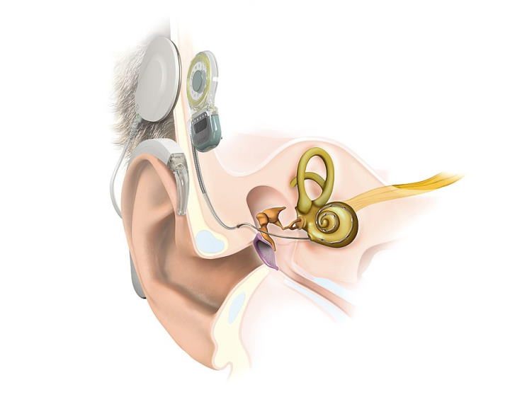 Tak prezentuje się wszczepiony implant ślimakowy. Źródło: Hear hear!/Creative Commons - Co w człowieku można wymienić na sztuczny zamiennik? - dokument - 2022-04-25