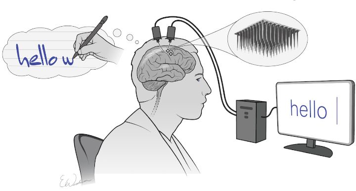 Implant mózgowy pozwolił sparaliżowanemu pisać za pomocą myśli - ilustracja #1