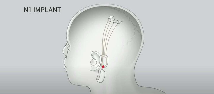 Implant Neuralink od Elona Muska odtworzy muzykę w mózgu - ilustracja #2