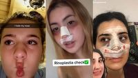 TikTok ma problem - reklamy operacji plastycznych żerują na nastolatkach